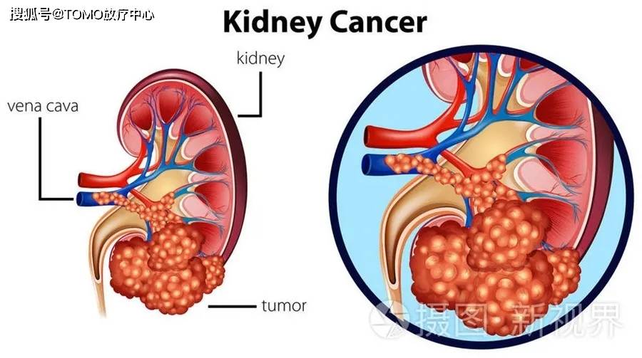 科学肾重与肾病相伴过健康人生不可不防肾癌