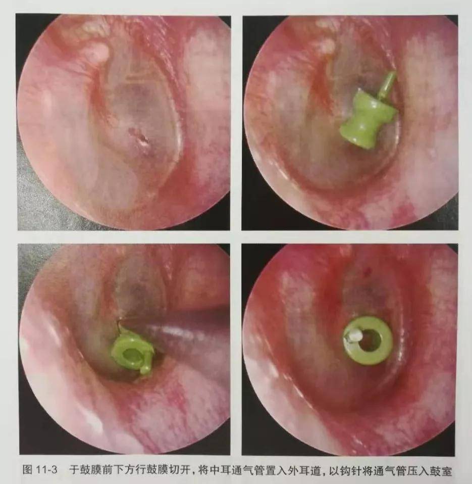 宝宝听力减退小心分泌性中耳炎