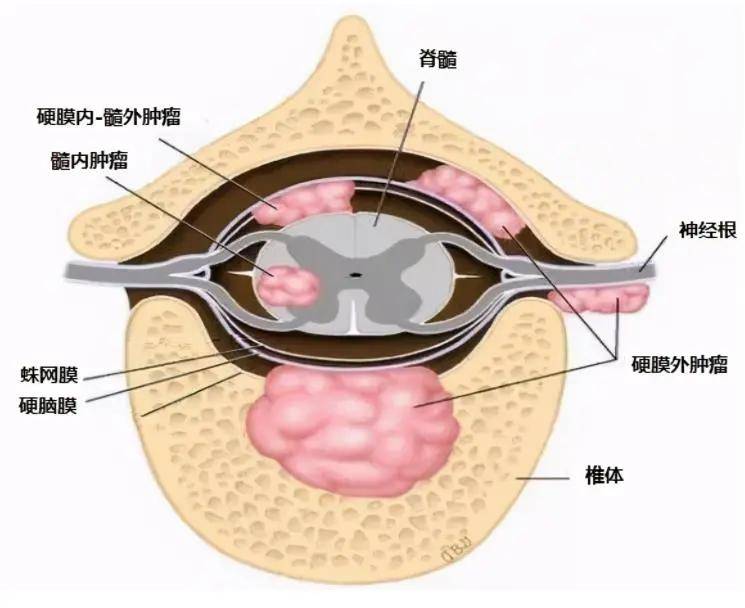 脊膜瘤险致下肢瘫痪神外骨科强强联手迎刃而解