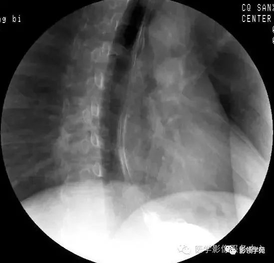 10种食管钡餐常见疾病图解