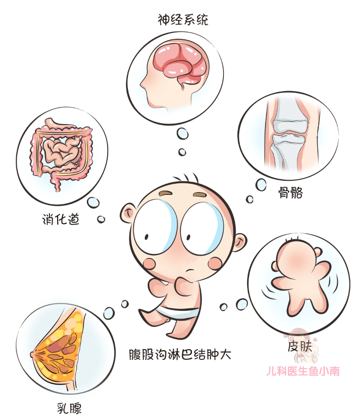 比如恶性淋巴瘤可以导致淋巴结肿大,肝脏,脾脏等器官出现疾病,消化道