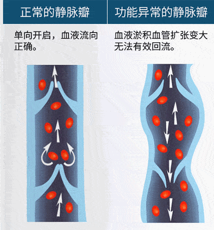 不仅精准疏通腿部滞留淋巴液,还能打通经络,加速血液循环,让堆积在