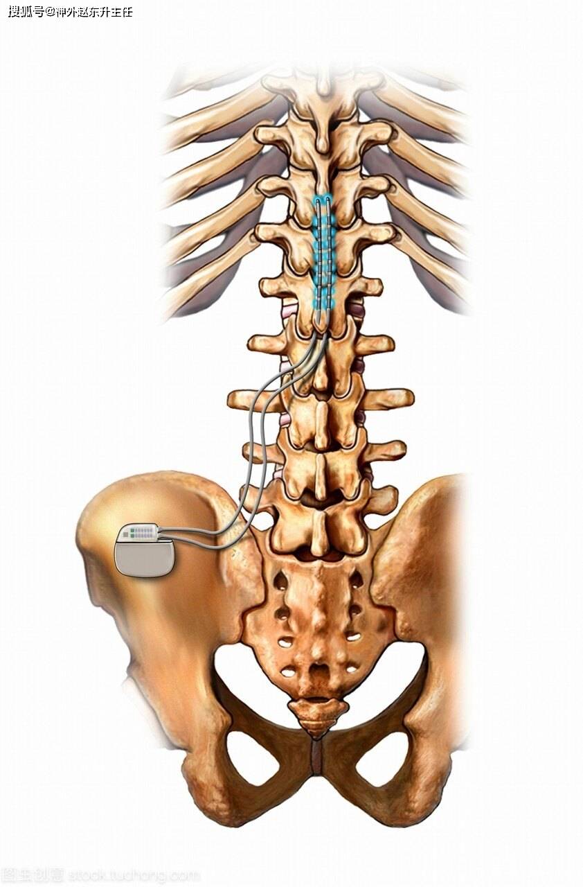 原创脊髓电刺激手术治疗脊髓损伤瘫痪