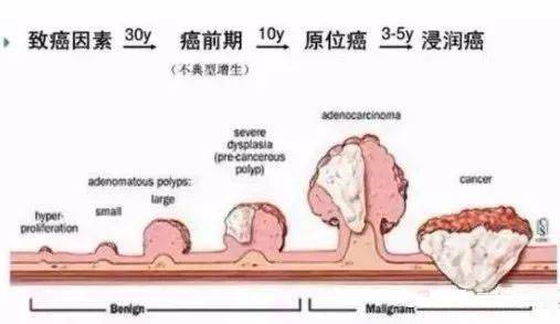 肠内癌变,大便先知?大便若有4种"异常",建议早做肠癌检查