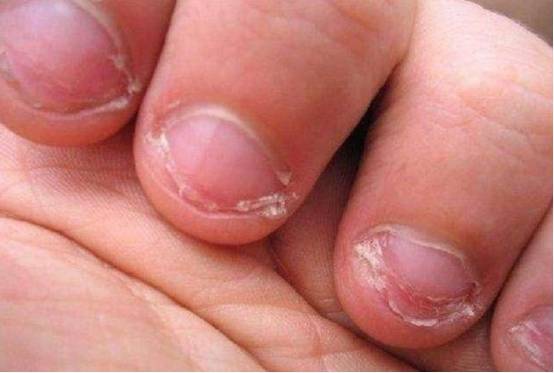 小孩总喜欢咬指甲有什么危害?有什么方法可以戒咬指甲