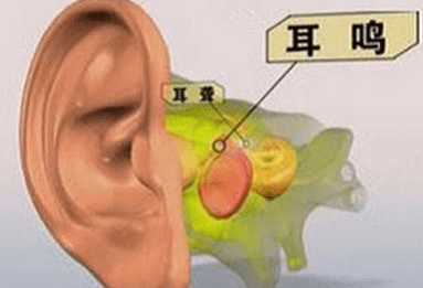 缓解耳鸣的简单方法----茂名惠耳听力助听器_症状