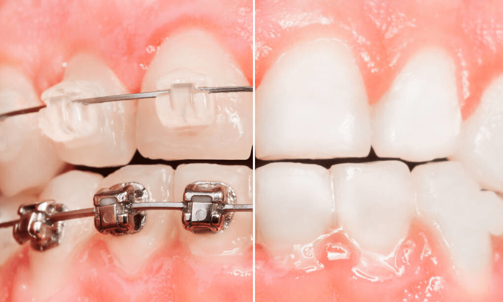 牙齿矫正需要多少钱?