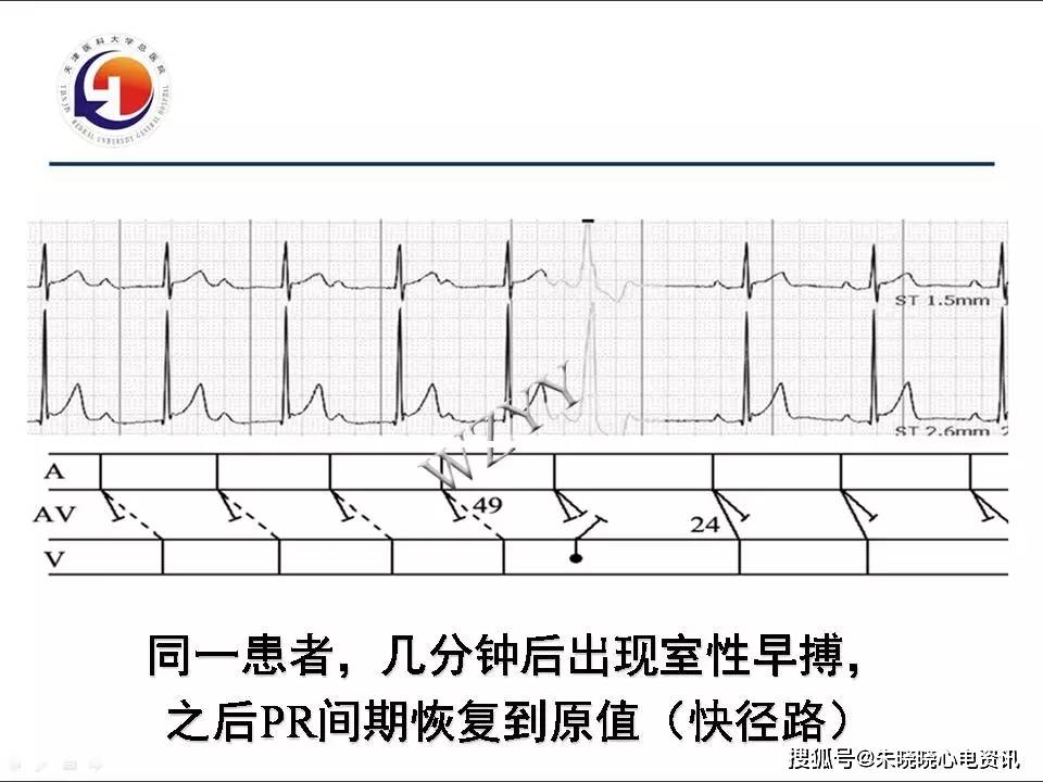 梯形图在疑难心电图诊断中的应用