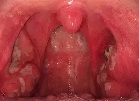 咽部后壁及扁桃体明显红肿充血 白点为脓性渗出液