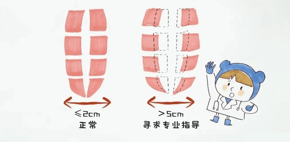 关于腹直肌分离的7大疑问答案都在这里