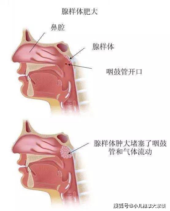 小儿推拿杨晓:什么是儿童腺样体肥大?必须要手术吗?如何调理?