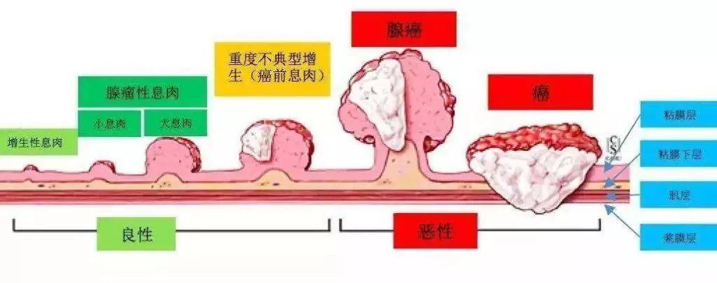 哪种息肉会变成恶性肿瘤?这3种息肉要重视,恶化概率较