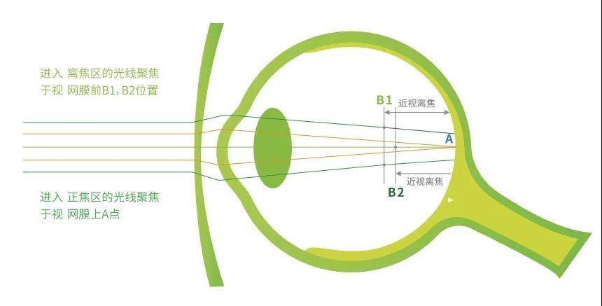 cma多点复合离焦镜片,它是青少年近视防控的开创性设计,采用公司自主