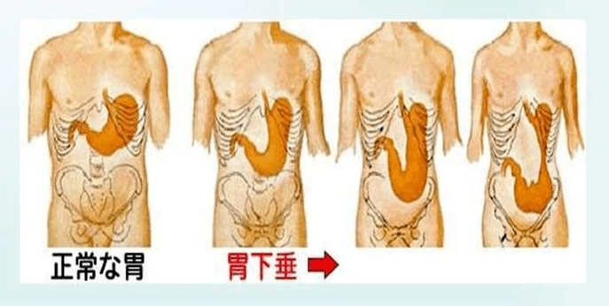 胃下垂常伴有十二指肠球部位置的改变.