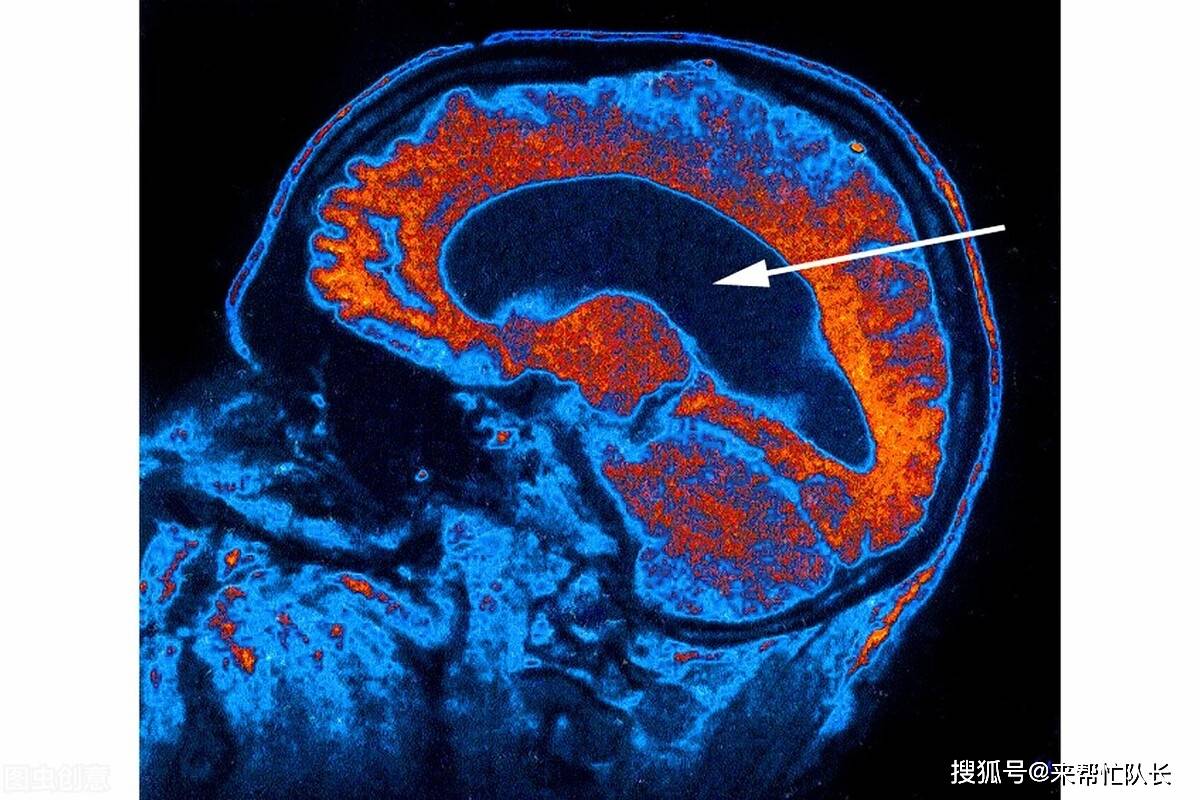 走路不稳,健忘,小便失禁…可能不是老年痴呆而是脑子进"水"了