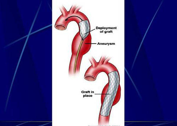 主动脉夹层累及到腹腔干动脉,肠系膜上动脉等分支,导致胃肠供应血管
