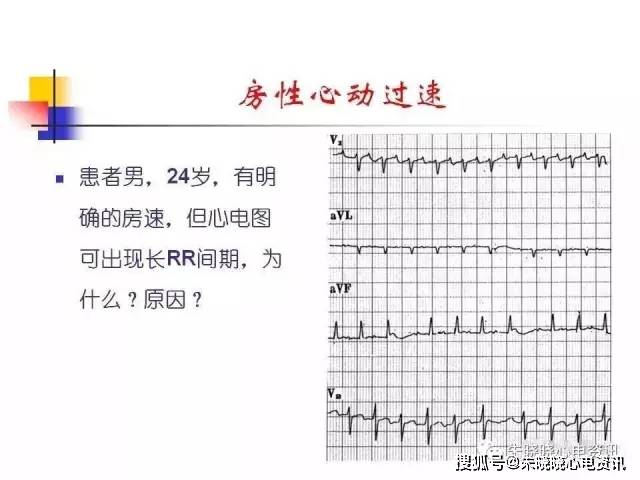 房速与房扑相关的心电问题