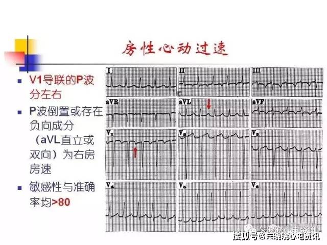 房速与房扑相关的心电问题