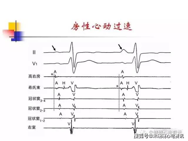 房速与房扑相关的心电问题