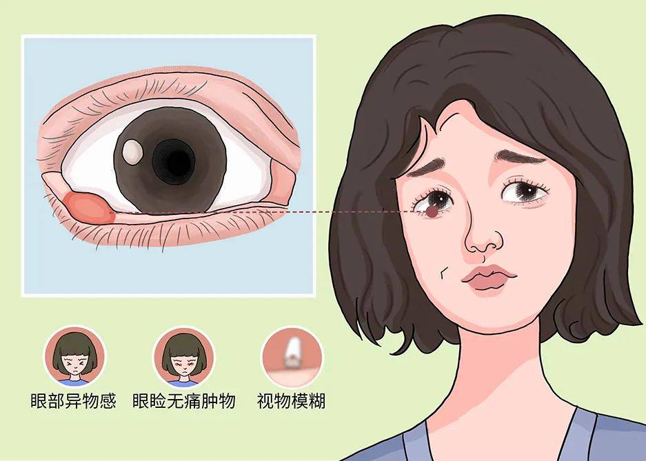 春季那些难缠的眼病最后一种还会致盲