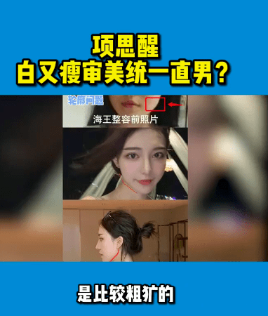 原创项思醒整容前后差异大up主分析其做了10个项目全脸基本都动过