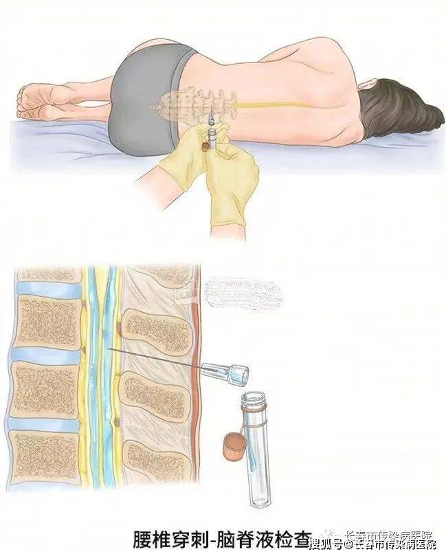 腰穿是腰椎穿刺术的简称;腰穿是利用腰椎穿刺针,经腰椎间隙到达蛛网膜