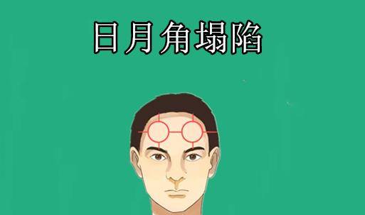 日月角塌陷