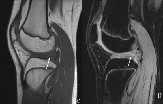 膝关节各种损伤的mri表现大集合_韧带