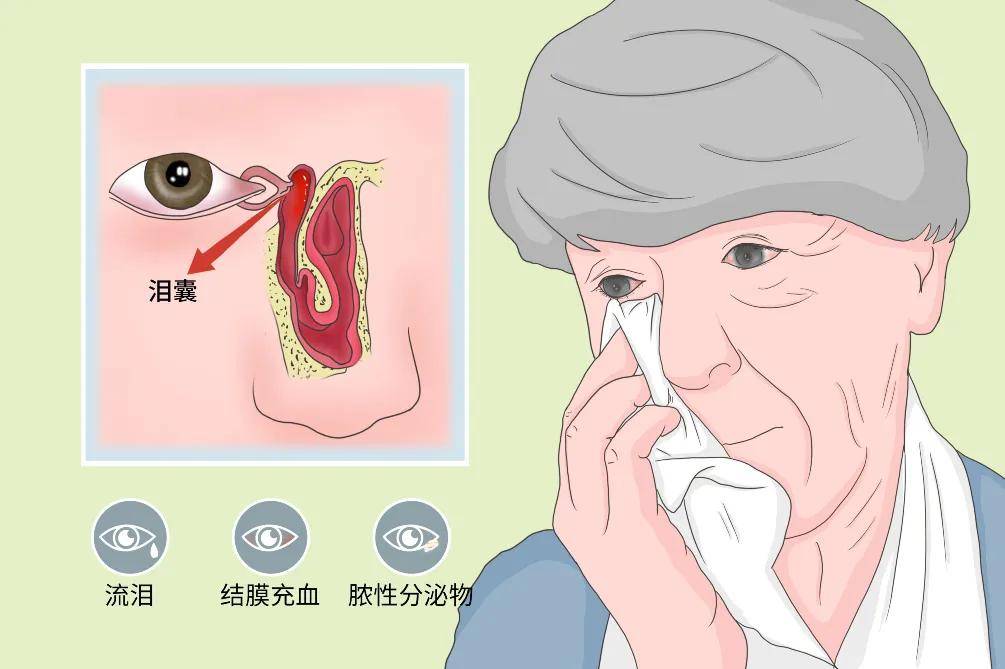 陈伟主任提醒,如不积极治疗,可能发展成急性泪囊炎,蜂窝织炎和泪囊