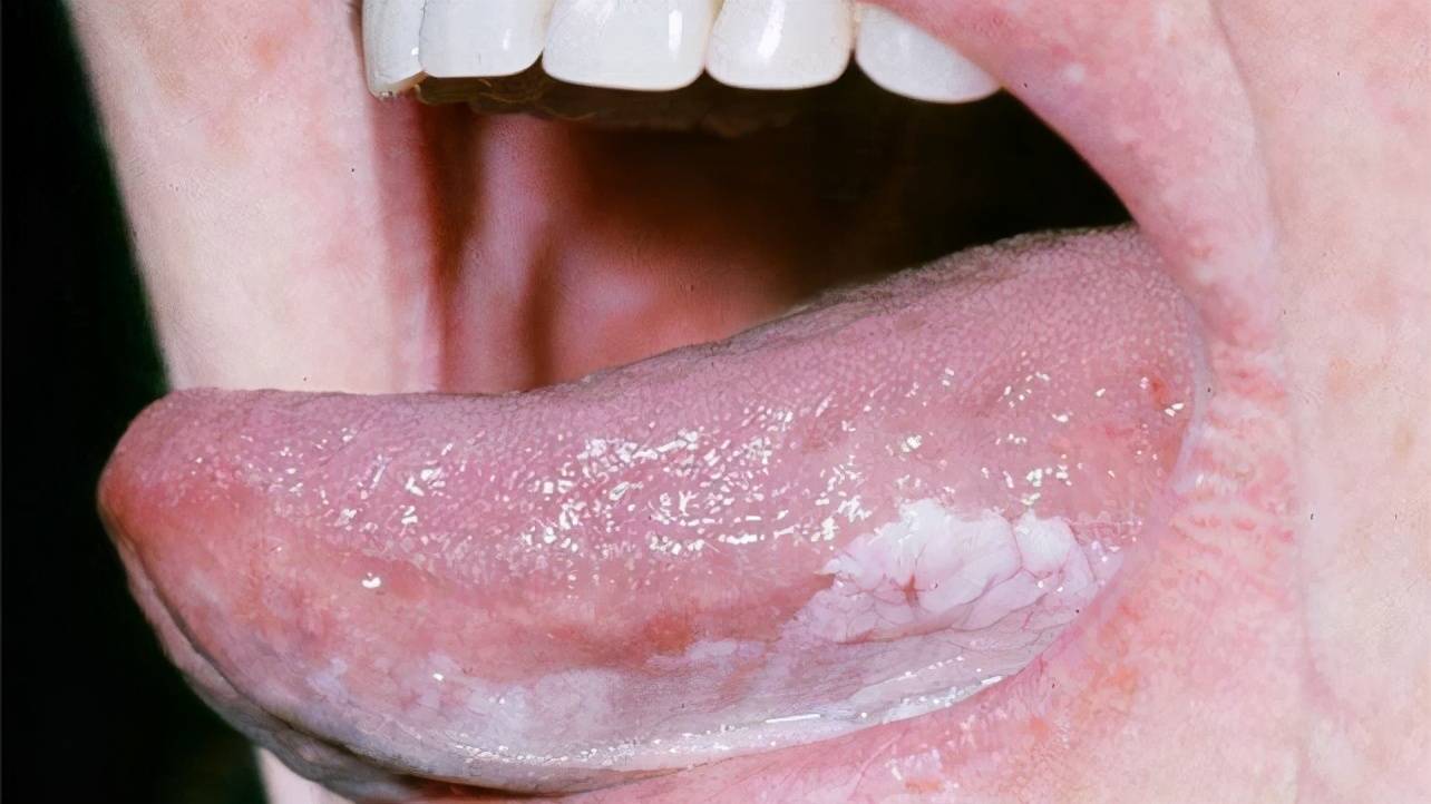 36岁男子口腔溃疡反复,去医院检查,却要切掉整个舌头