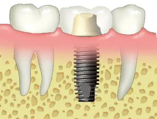 种植牙会发炎,种植牙术后保养要注意这几点