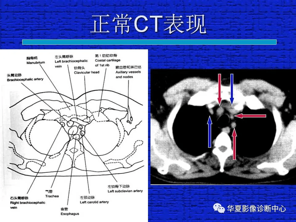 ct入门 | 结合解剖谈正常胸部ct读片