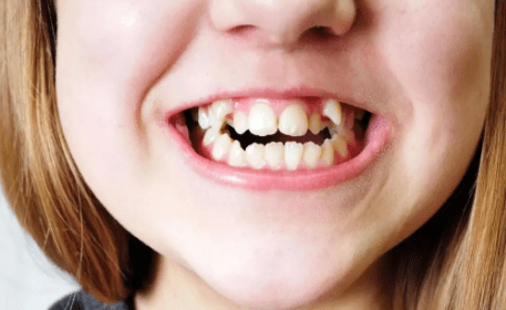 擅长自我清洁,不容易积攒食物残渣,因此虎牙作为全口牙中最干净的牙齿
