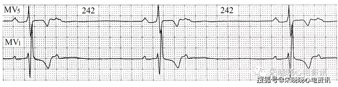 (3)过缓的窦性搏动伴未下传房性早搏二联律(图7-31),未下传成对房性