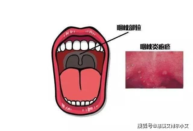 上火?口腔溃疡?流感?不不不,这是 "疱疹性咽峡炎"!