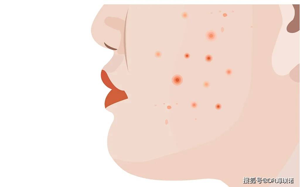 油痘肌特点 面部肌肤容易长痘,发痒,甚至出现脱皮,但是脸上却是油光