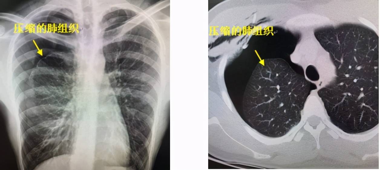 经过检查,小阳原来是突发了"自发性气胸,右肺已经被压缩了50.