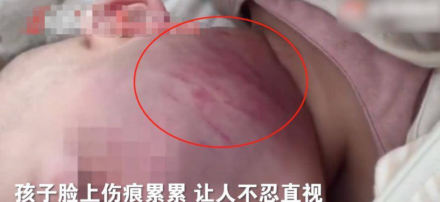 气愤!9个月的婴儿被亲生父亲连扇耳光,脸上伤痕累累