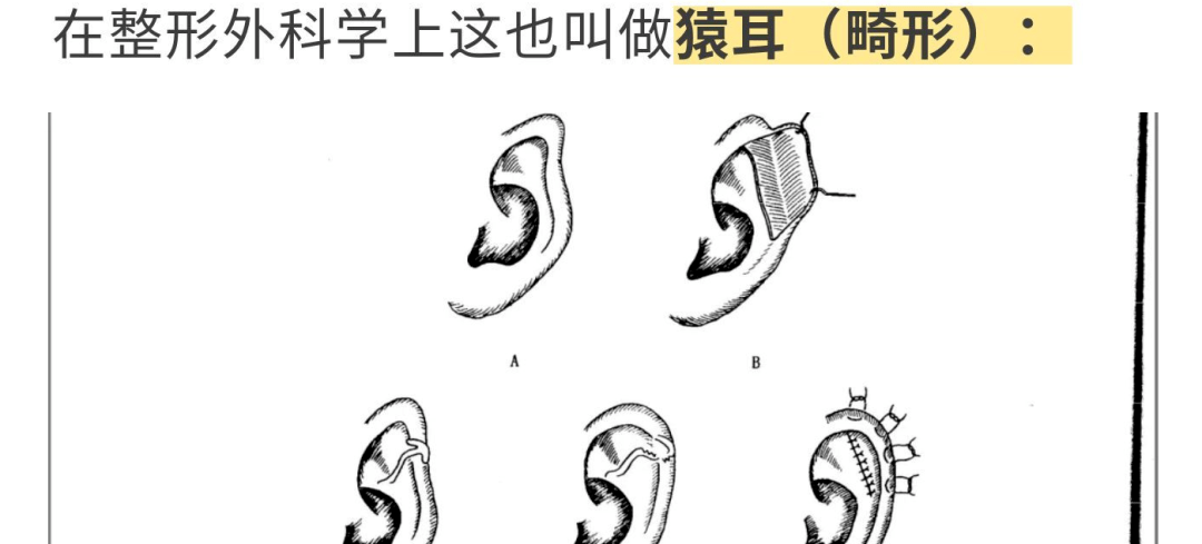 当容貌焦虑内卷到耳朵,是谁在向孩子传播畸形审美?