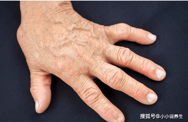 肺部有癌,手指先知!手指出现这个症状,警惕被肺癌缠上