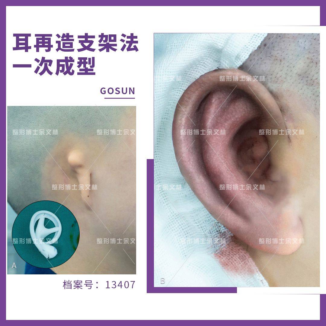 一次成形耳再造手术安全吗?会不会很痛?