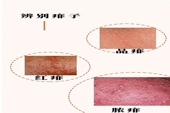 宝宝身上起了痱子,但又不能用痱子粉,那该怎么做？