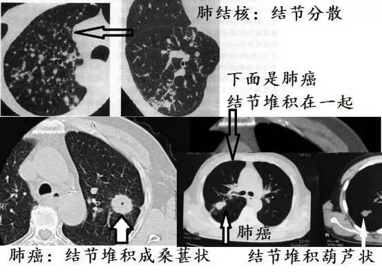 查出肺结节,到底切还是不切?