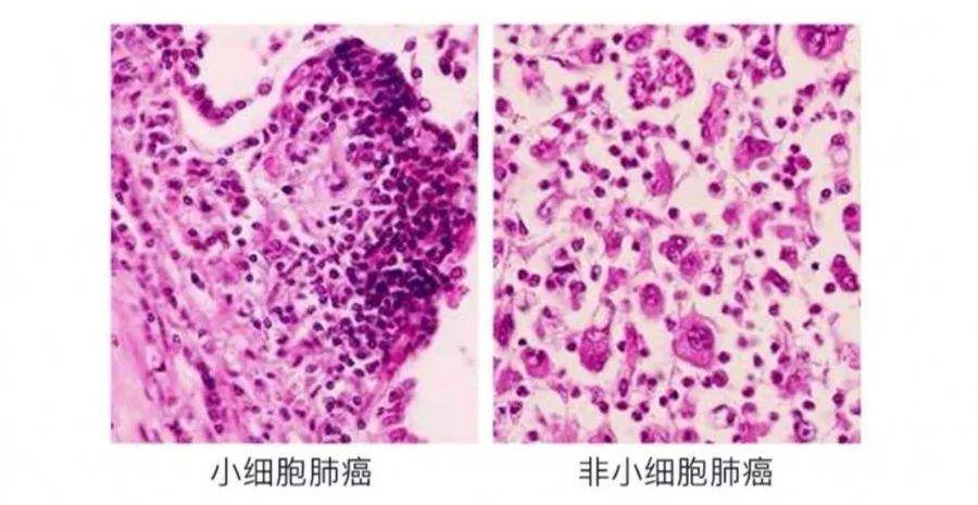 信达生物:国产创新药获批应用于晚期鳞状非小细胞肺癌治疗