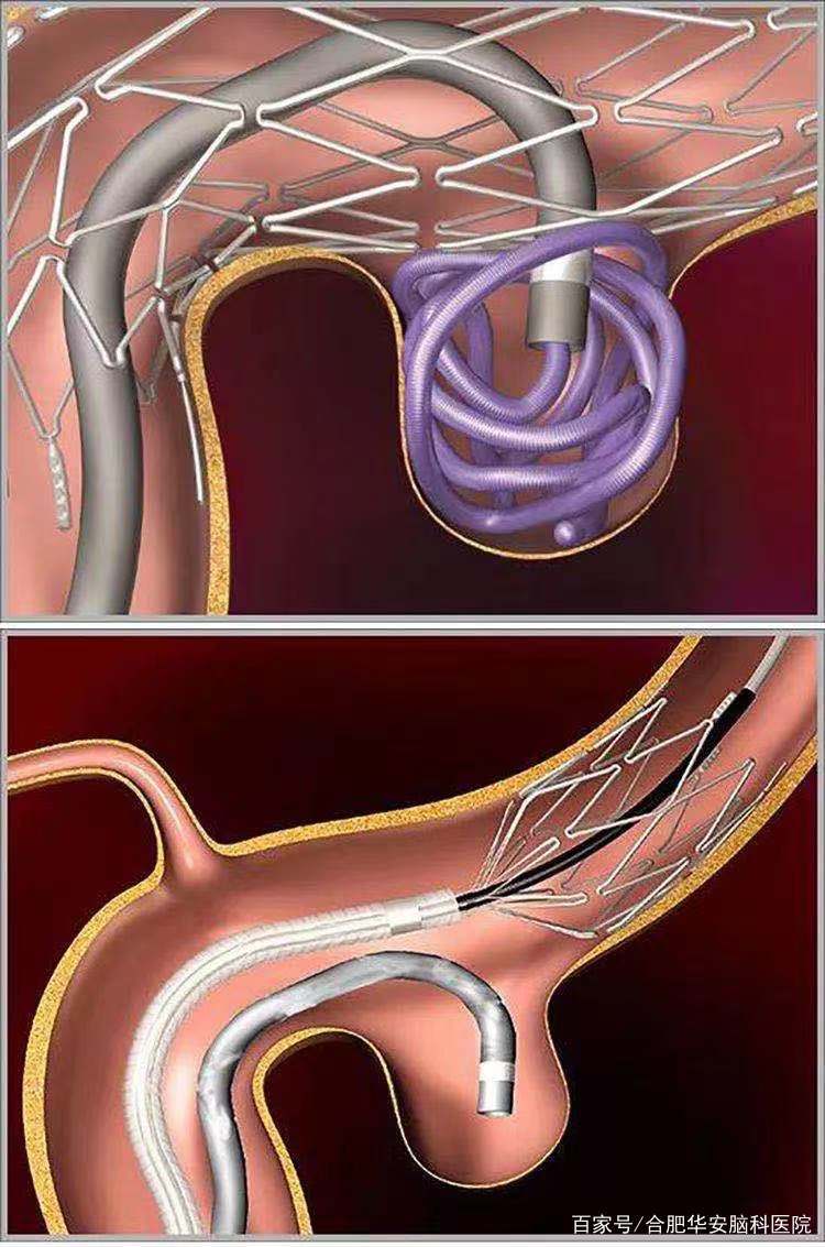 动脉瘤夹闭术 直到上个世纪90年代,以弹簧圈为代表的介入栓塞治疗方法