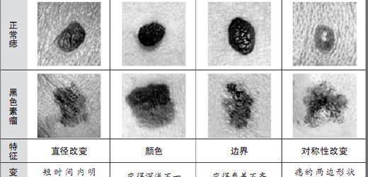 看颜色:痣的常见颜色有黑色,红色,蓝色相对于黑色和红色蓝色更易癌变