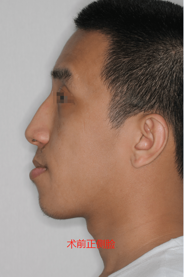 术前正侧脸,脸型较长,下唇比上唇看上去厚且突出,典型地包天.