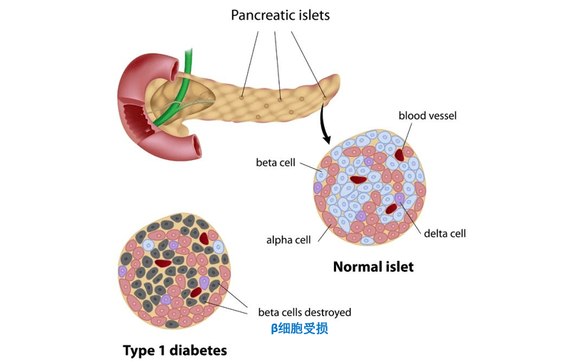 胰岛β细胞高效生成,治愈1型糖尿病值得期待