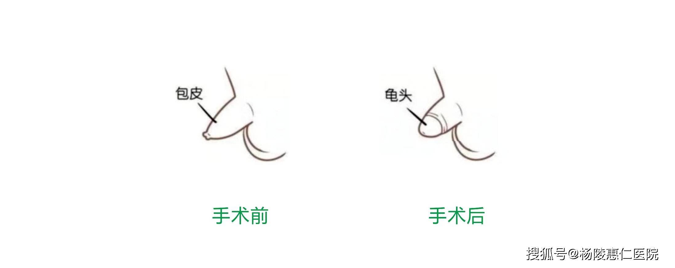 关于包皮,你应该了解的那些事!_手术