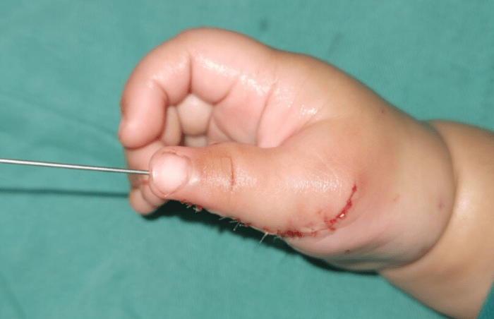 孩子多指手术后多久能恢复?